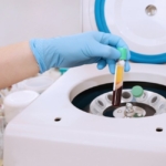 prp tedavisi diz (2)