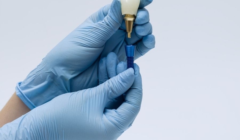 Diş İmplantlarıyla Kalıcı ve Doğal Gülüşler